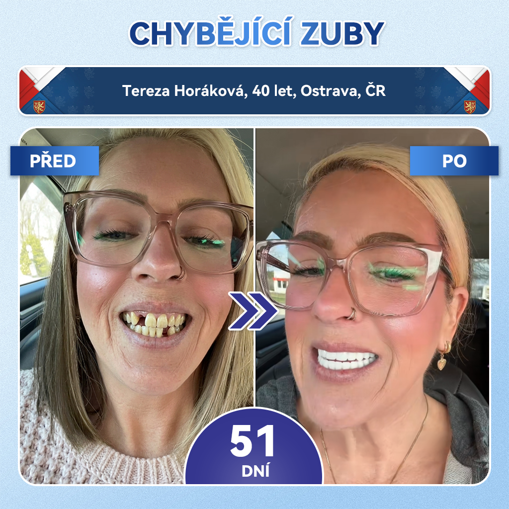 𝑮𝒍𝒊𝑚𝑚𝒆𝒓𝒍𝒚®🦷 𝑻𝒊𝒅𝒆𝒈𝒍𝒖𝒔𝒊𝒃 𝑴𝒊𝒄𝒓𝒐𝒏𝒆𝒆𝒅𝒍𝒆 𝑷𝒂𝒕𝒄𝒉 𝒏𝒂 𝒐𝒑𝒓𝒂𝒗𝒖 𝒛𝒖𝒃ů 𝒂 𝒅á𝒔𝒏í | 𝐏𝐨𝐤𝐫𝐨č𝐢𝐥é 𝐧á𝐩𝐥𝐚𝐬𝐭𝐢 𝐩𝐫𝐨 𝐚𝐤𝐭𝐢𝐯𝐚𝐜𝐢 𝐤𝐦𝐞𝐧𝐨𝐯ý𝐜𝐡 𝐛𝐮𝐧ě𝐤 𝐳𝐮𝐛ů 👩‍⚕️(𝑂𝑏𝑛𝑜𝑣𝑎 𝑧𝑢𝑏𝑛í 𝑠𝑘𝑙𝑜𝑣𝑖𝑛𝑦 𝑎 𝑑𝑒𝑛𝑡𝑖𝑛𝑢 • 𝑃𝑜𝑠í𝑙𝑒𝑛í 𝑑á𝑠𝑛í • 𝑂𝑑𝑠𝑡𝑟𝑎𝑛ě𝑛í 𝑧𝑢𝑏𝑛íℎ𝑜 𝑘𝑎𝑚𝑒𝑛𝑒 𝑎 𝑧á𝑝𝑎𝑐ℎ𝑢 • 𝑍𝑎𝑠𝑡𝑎𝑣𝑒𝑛í 𝑐𝑖𝑡𝑙𝑖𝑣𝑜𝑠𝑡𝑖 𝑧𝑢𝑏ů)🔥