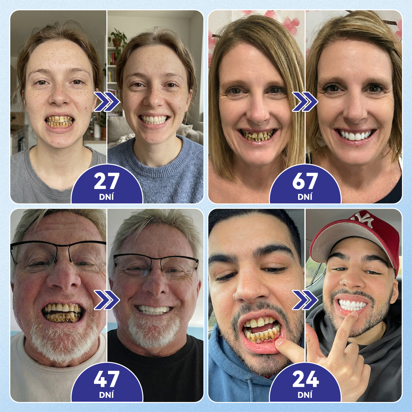 𝑮𝒍𝒊𝑚𝑚𝒆𝒓𝒍𝒚®🦷 𝑻𝒊𝒅𝒆𝒈𝒍𝒖𝒔𝒊𝒃 𝑴𝒊𝒄𝒓𝒐𝒏𝒆𝒆𝒅𝒍𝒆 𝑷𝒂𝒕𝒄𝒉 𝒏𝒂 𝒐𝒑𝒓𝒂𝒗𝒖 𝒛𝒖𝒃ů 𝒂 𝒅á𝒔𝒏í | 𝐏𝐨𝐤𝐫𝐨č𝐢𝐥é 𝐧á𝐩𝐥𝐚𝐬𝐭𝐢 𝐩𝐫𝐨 𝐚𝐤𝐭𝐢𝐯𝐚𝐜𝐢 𝐤𝐦𝐞𝐧𝐨𝐯ý𝐜𝐡 𝐛𝐮𝐧ě𝐤 𝐳𝐮𝐛ů 👩‍⚕️(𝑂𝑏𝑛𝑜𝑣𝑎 𝑧𝑢𝑏𝑛í 𝑠𝑘𝑙𝑜𝑣𝑖𝑛𝑦 𝑎 𝑑𝑒𝑛𝑡𝑖𝑛𝑢 • 𝑃𝑜𝑠í𝑙𝑒𝑛í 𝑑á𝑠𝑛í • 𝑂𝑑𝑠𝑡𝑟𝑎𝑛ě𝑛í 𝑧𝑢𝑏𝑛íℎ𝑜 𝑘𝑎𝑚𝑒𝑛𝑒 𝑎 𝑧á𝑝𝑎𝑐ℎ𝑢 • 𝑍𝑎𝑠𝑡𝑎𝑣𝑒𝑛í 𝑐𝑖𝑡𝑙𝑖𝑣𝑜𝑠𝑡𝑖 𝑧𝑢𝑏ů)🔥